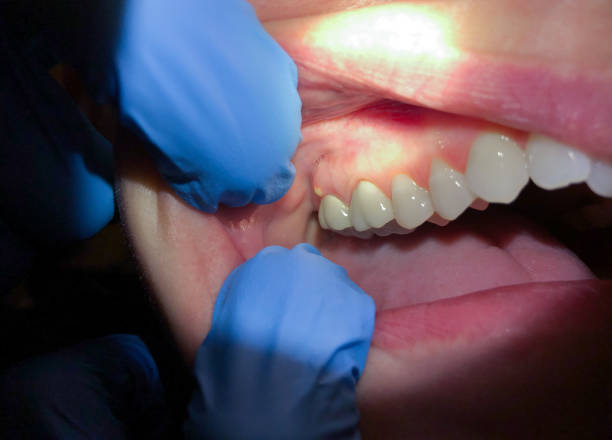 Best Broken or Chipped Tooth Repair in South Chicago Heights, IL